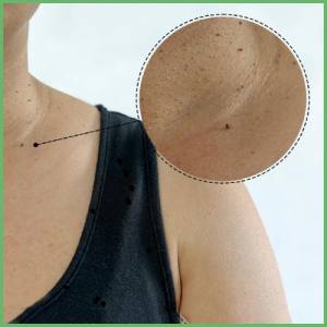 Skin signs of insulin resistance